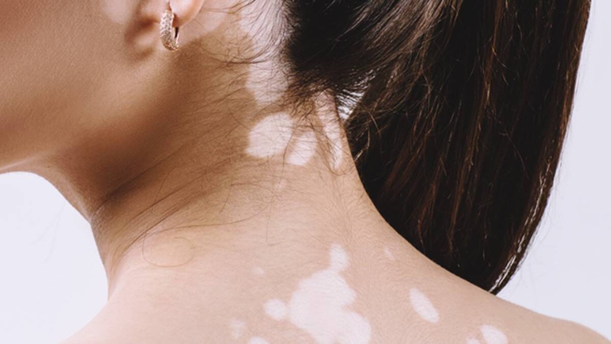 What Are The Symptoms Of Vitiligo?