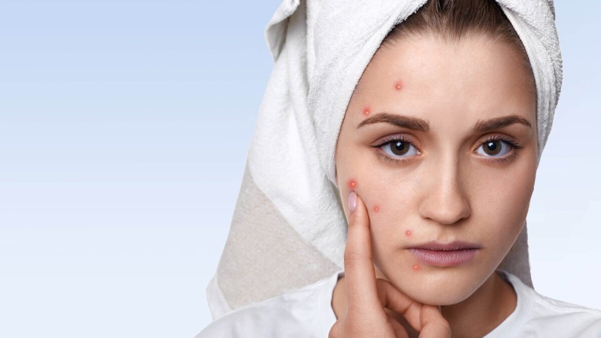 How To Prevent Acne & Pimples – 7 Effective Tips To Avoid Breakouts