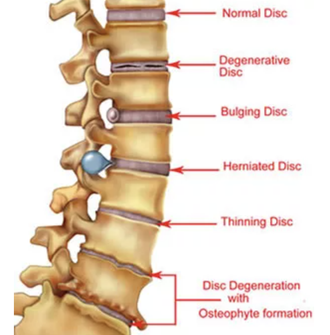 Physical therapy for herniated disc