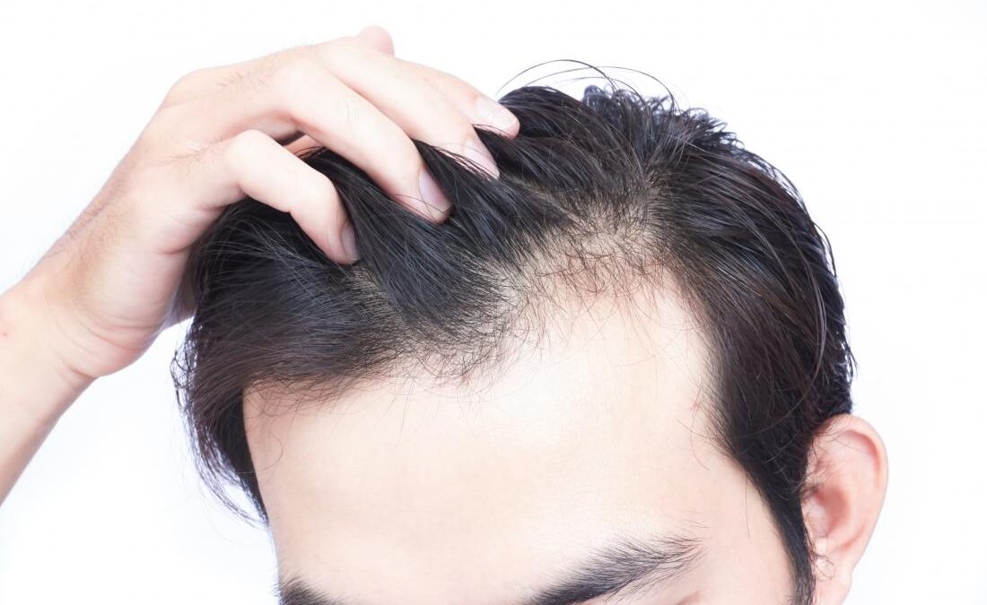WHAT IS EXPECTED AFTER HAIR TRANSPLANT SURGERY?