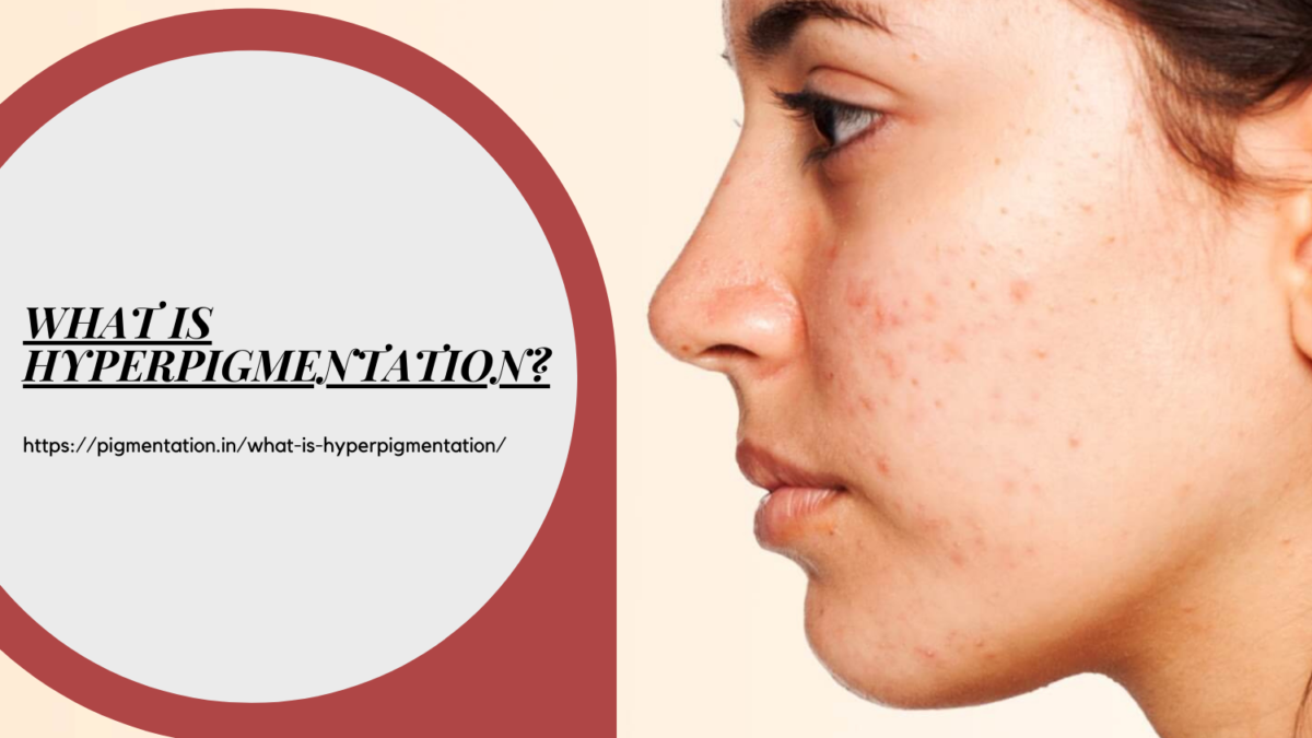 What You Should Know About Hyperpigmentation?