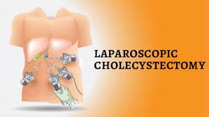 Laparoscopic cholecystectomy 