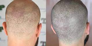 How to get the best hair FUE transplant  cost in 2021?