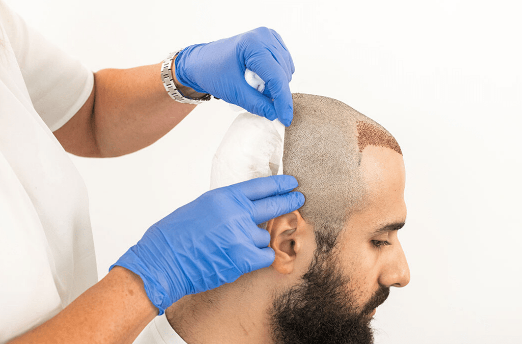The Ultimate Guide To Facial Hair Transplant