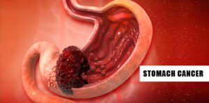 Stomach/Gastric Cancer Treatment in Delhi