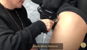 Stretch Mark Removal
