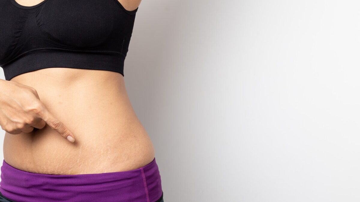 Make Your Way to a Smooth Skin with a Low Stretch Mark Removal Cost!