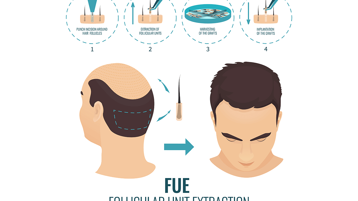 Is FUE hair transplant worth the money?