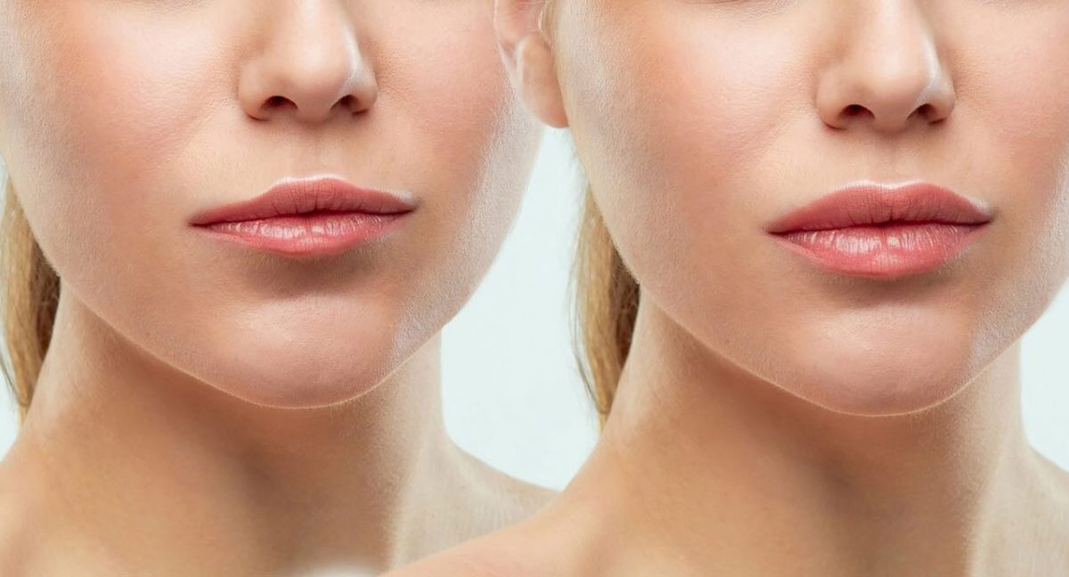 5 Frequently Asked Questions About Bullhorn Lip Lift