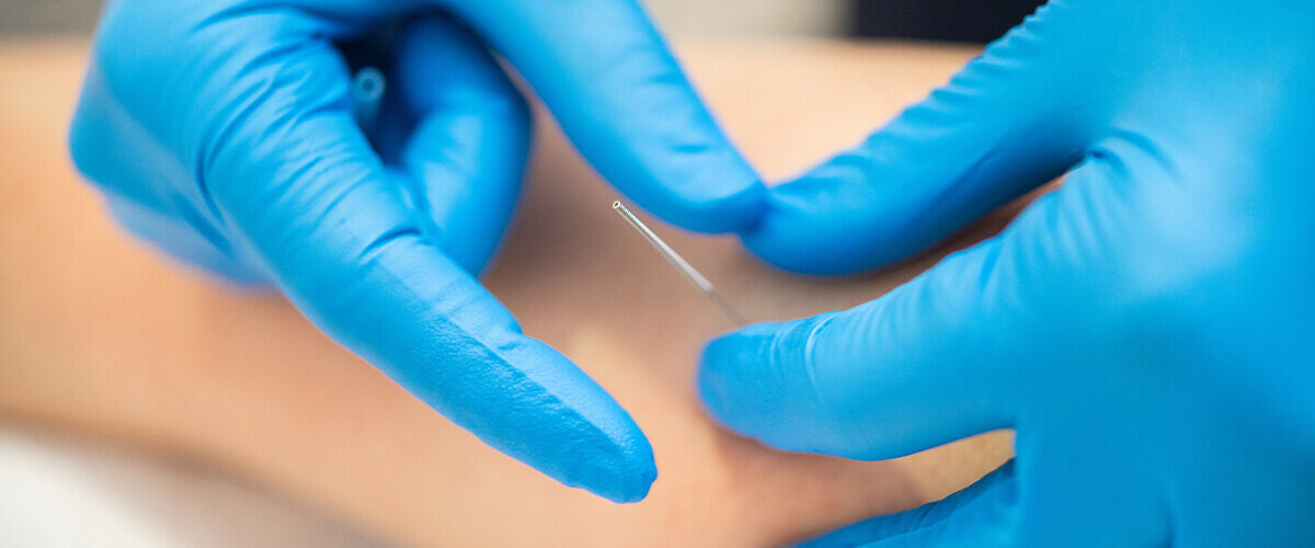 Dry Needling by a Physical Therapist: What You Should Know