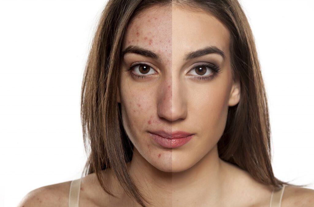 10 Unexpected Home Remedies That Can Help You Fight Acne