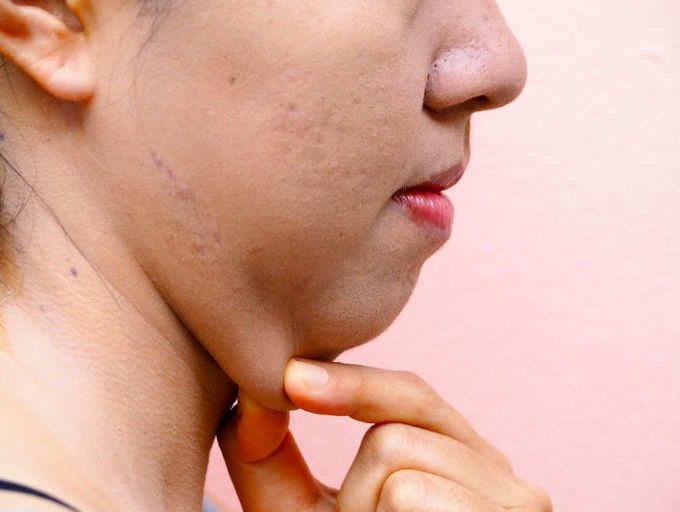 How to Reduce Sagging Jowls Through Face Yoga