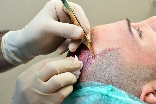 IS IT WORTH UNDERGOING A HAIR TRANSPLANT?