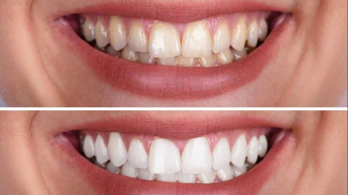 Crest Whitening Strips : Are They Beneficial?