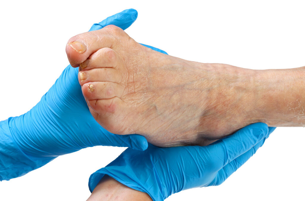 Bunion Deformity: Causes and Treatment