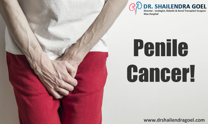 PENILE CANCER: KNOW THE CAUSES, SYMPTOMS AND TREATMENTS