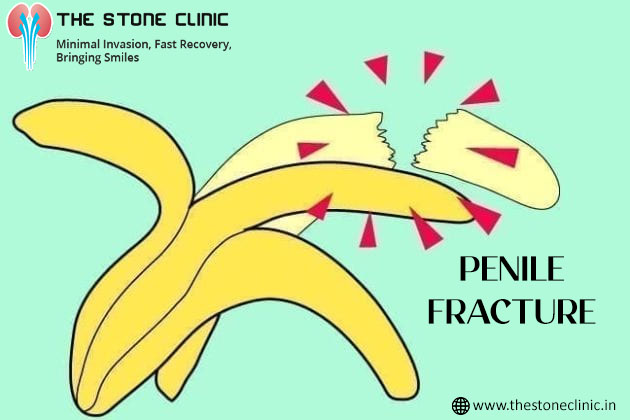 How to identify and treat penile fracture