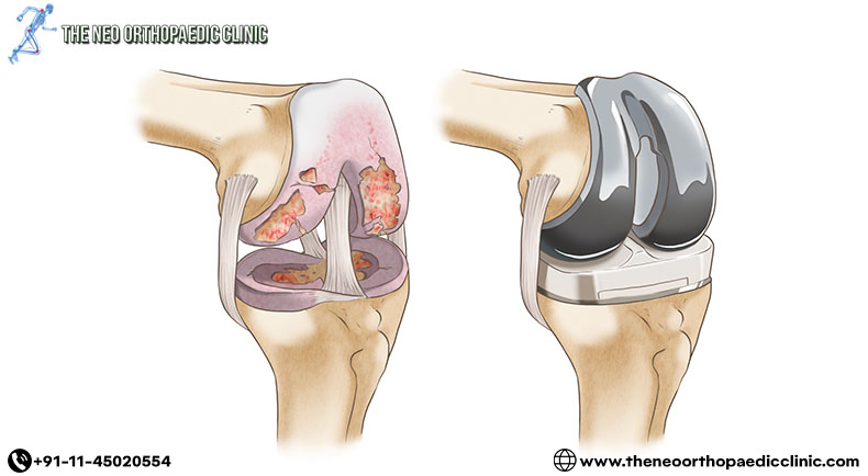 What is a total knee replacement?