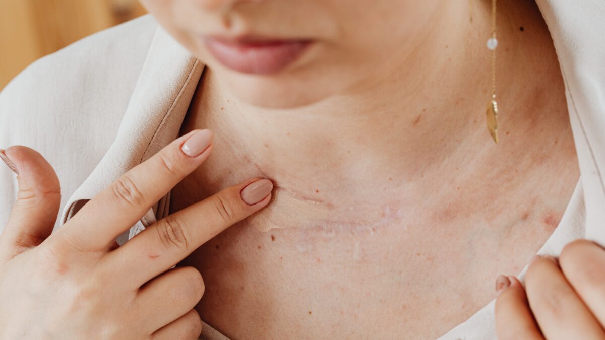The Definitive Guide To Scars and Treatments To Get Rid Of Them