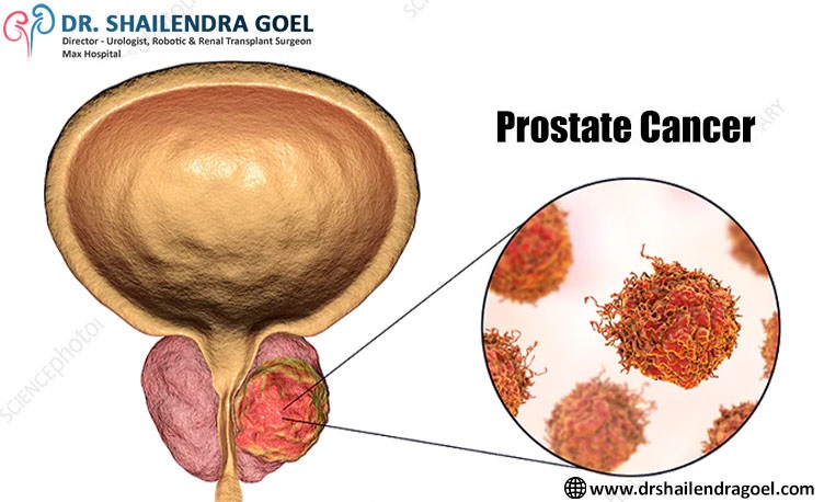 Prostate Cancer: Symptoms and Treatment options