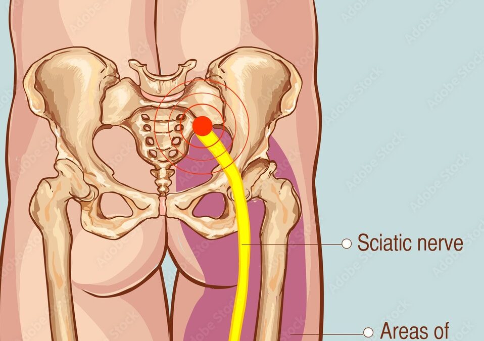 5 Essential Guidelines When Choosing A Chiropractor For Sciatica