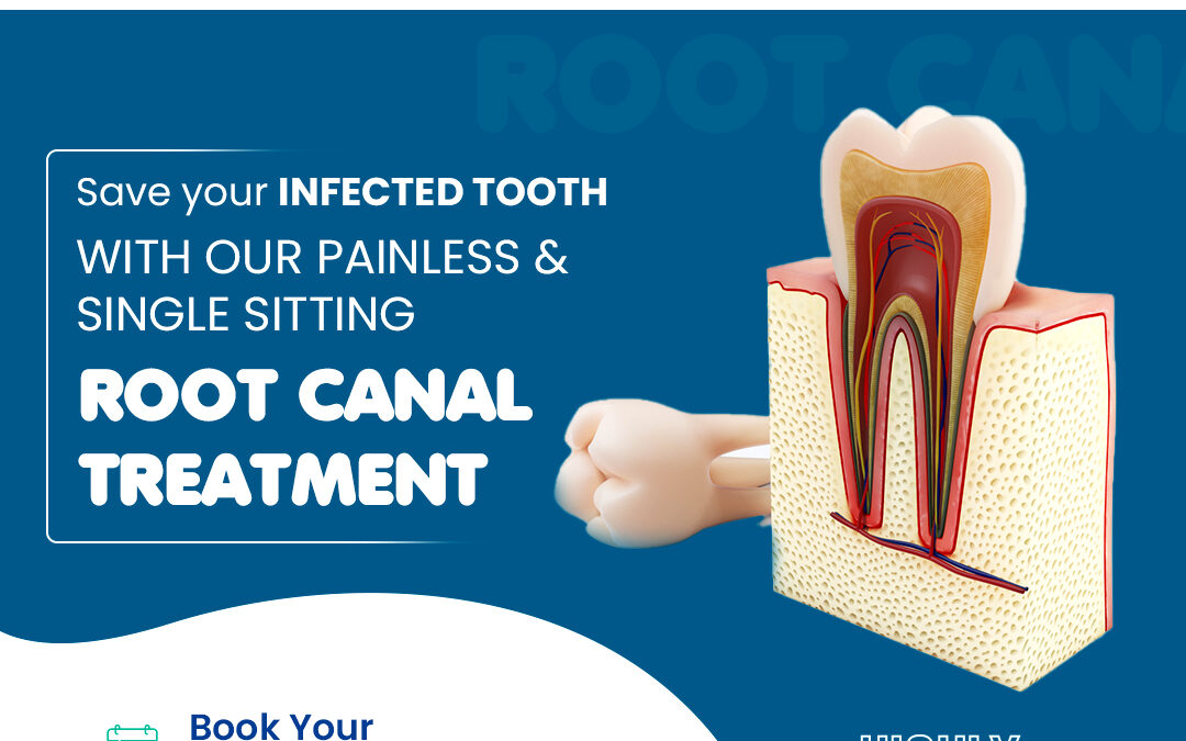 When do you need a Root Canal Treatment ?