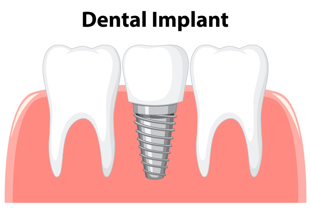 Why should you select dental implants for missing tooth?