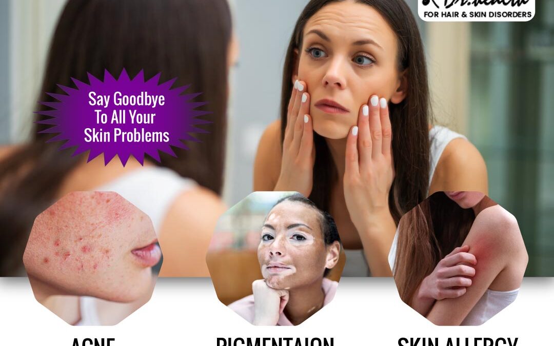 How can I prevent acne scars? Can treatment remove acne scars permanently?