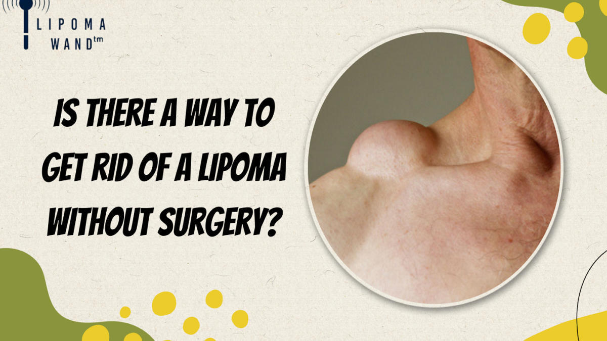 Is There a Way to Get Rid of a Lipoma Without Surgery?