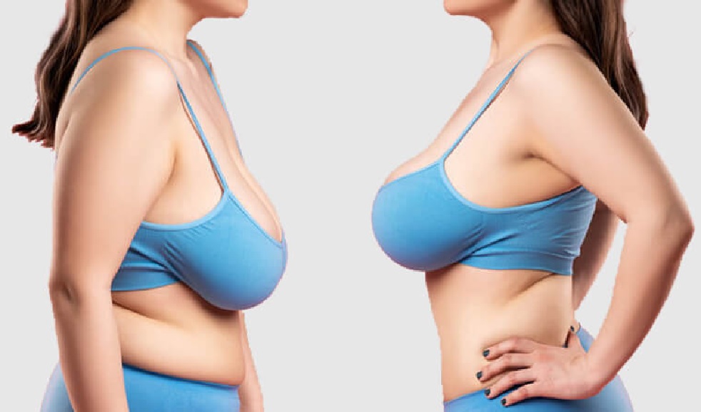 Differences between mammoplasty and mastopexy