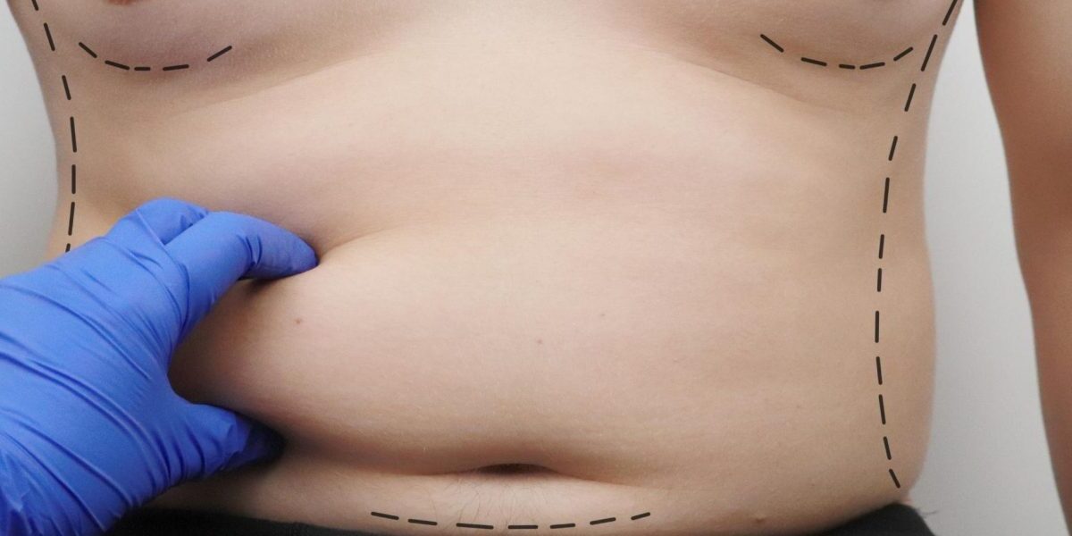 Liposuction to Remove Belly Fat