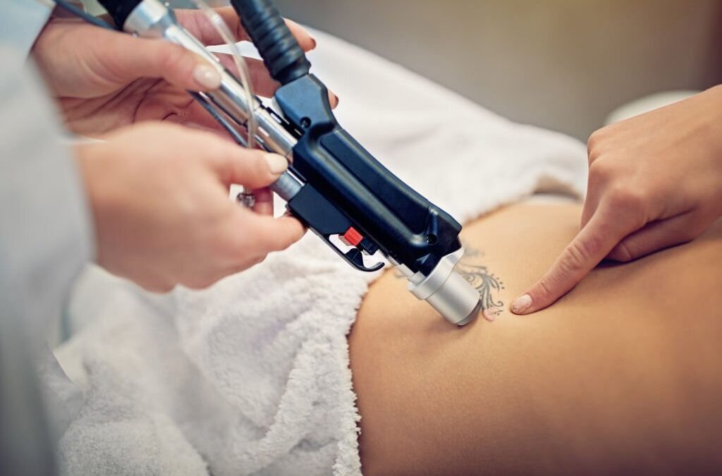 HOW LASER TATTOO REMOVAL WORKS