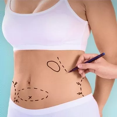 Non-Invasive Liposuction in Dubai