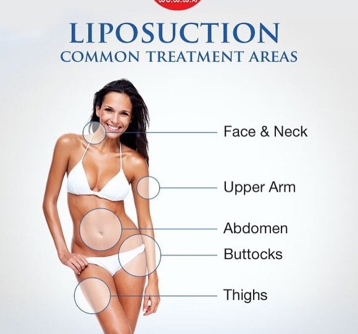 Top Liposuction Surgery Tips You Don’t Want to Miss