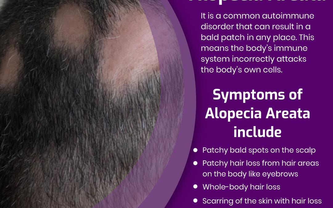 Learn About How Immune System Controls Alopecia Areata