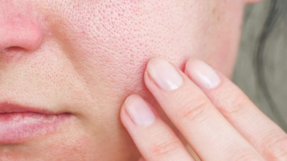 Proven Techniques for Removing Blackheads and Unclogging Pores
