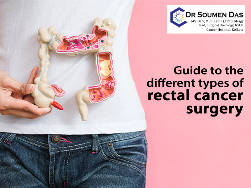 Guide to the different types of rectal cancer surgery says cancer surgeon