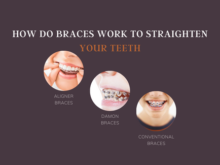 How Do Braces Work to Straighten Your Teeth