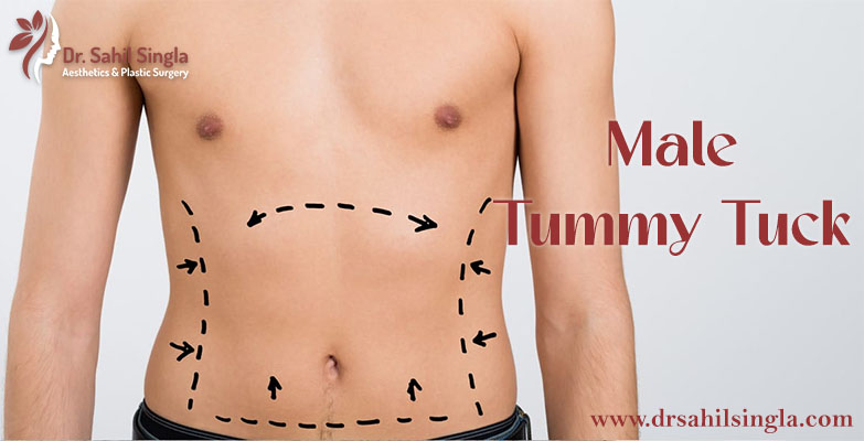 Male Tummy Tuck: What it is, Benefits and Treatments