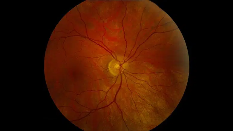 What is Optic Nerve Hypoplasia, Its Symptoms, and Causes?