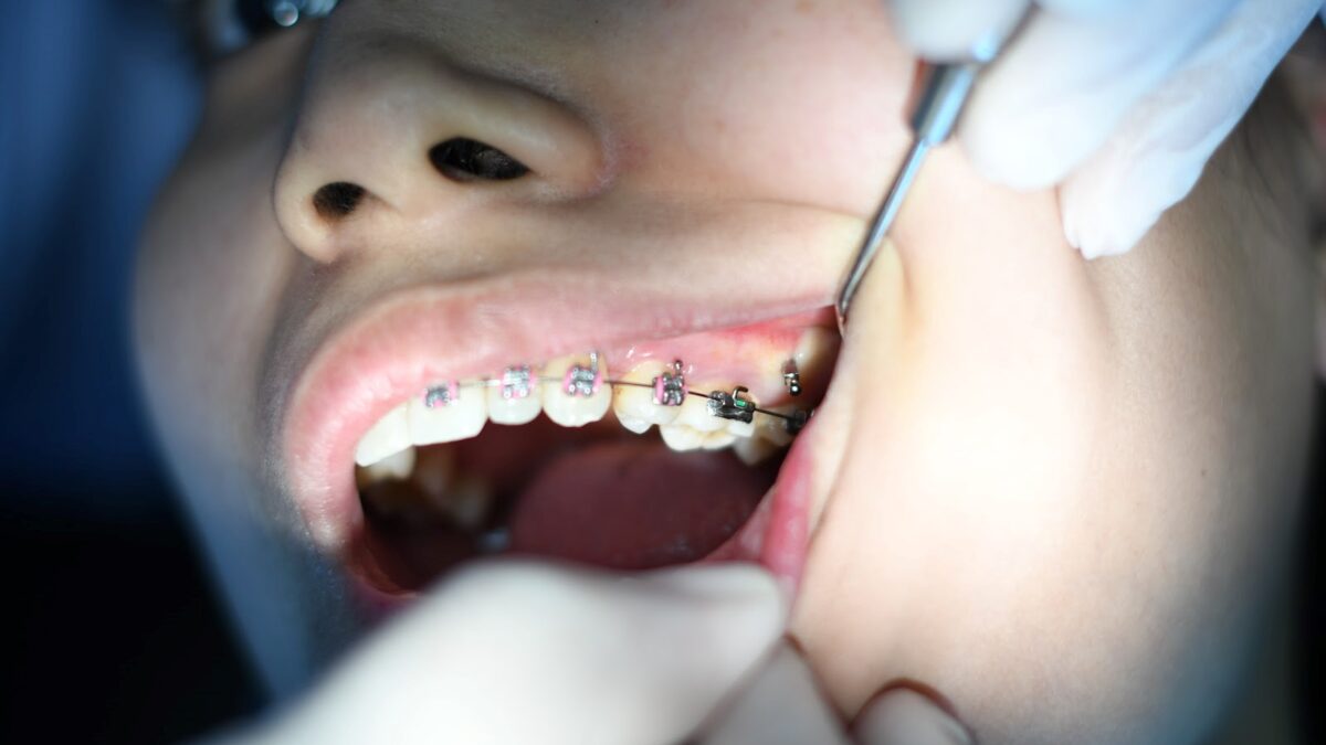 Effect Of Veneers Application On Oral health