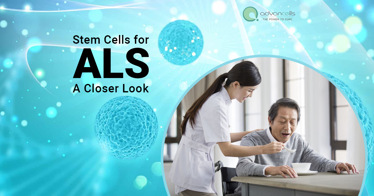 Stem Cells for ALS Treatment- A Closer Look