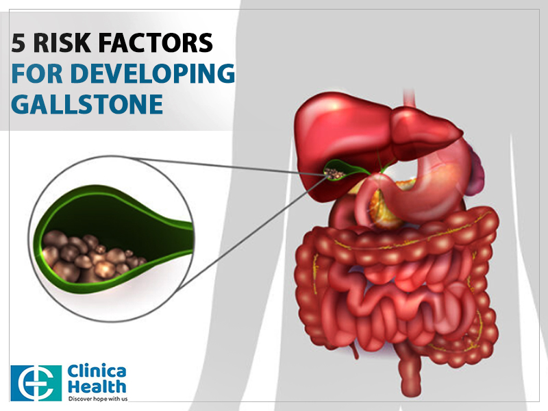 5 risk factors for developing gallstone