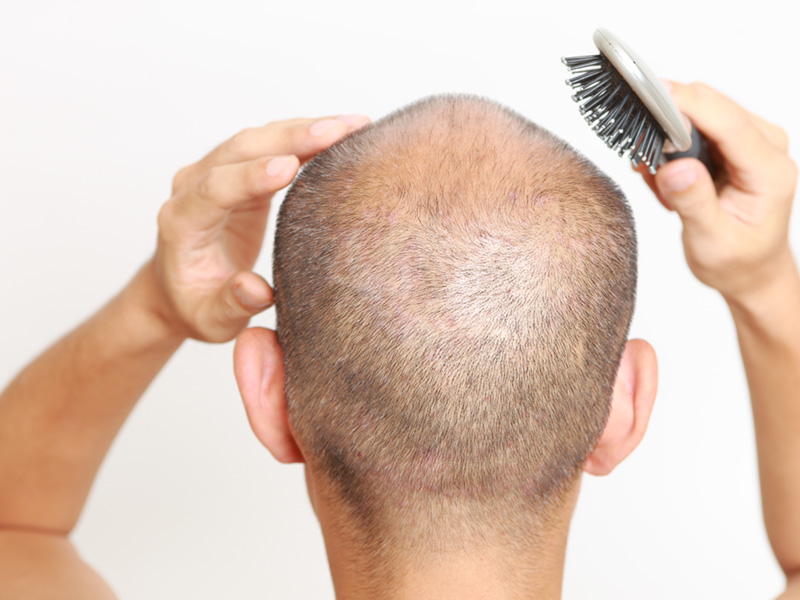 Can I Get Hair Transplant Without Shaving Head?