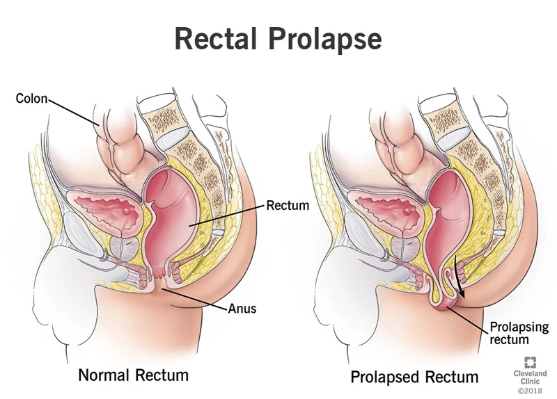 How do You Recognize If You have Rectal Prolapse?
