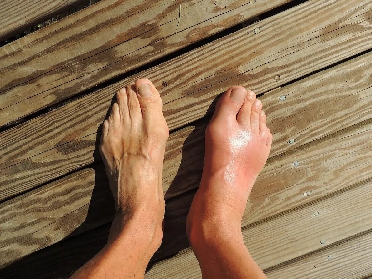 How to Treat Edema and What It Is?