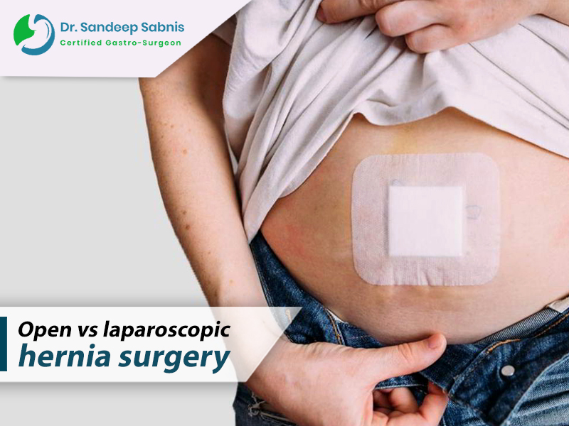 Open Vs Laparoscopic Hernia Surgery: Which is the Best Procedure