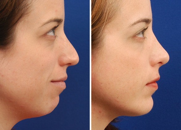 What is chin implant surgery & Why should you consider Chin Implant Surgery?