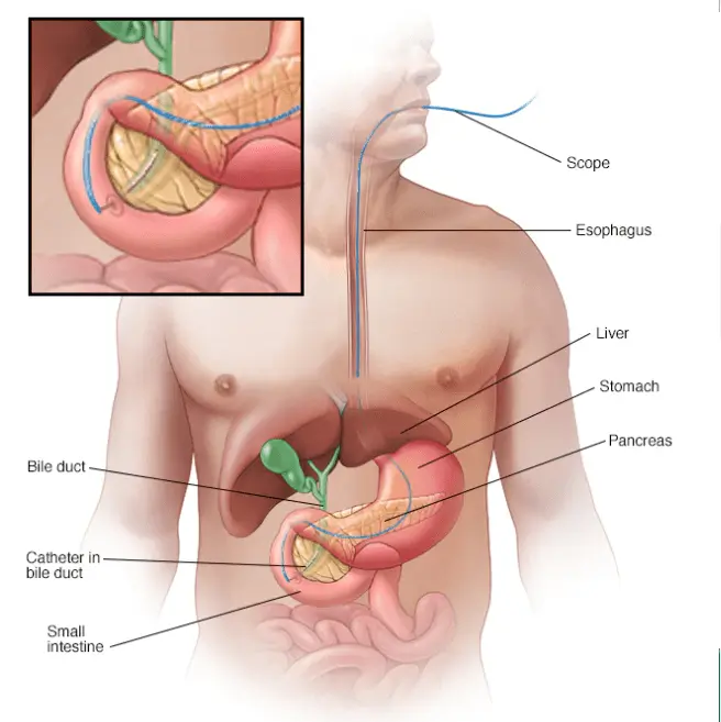 Gallbladder After Medical procedure Difficulties