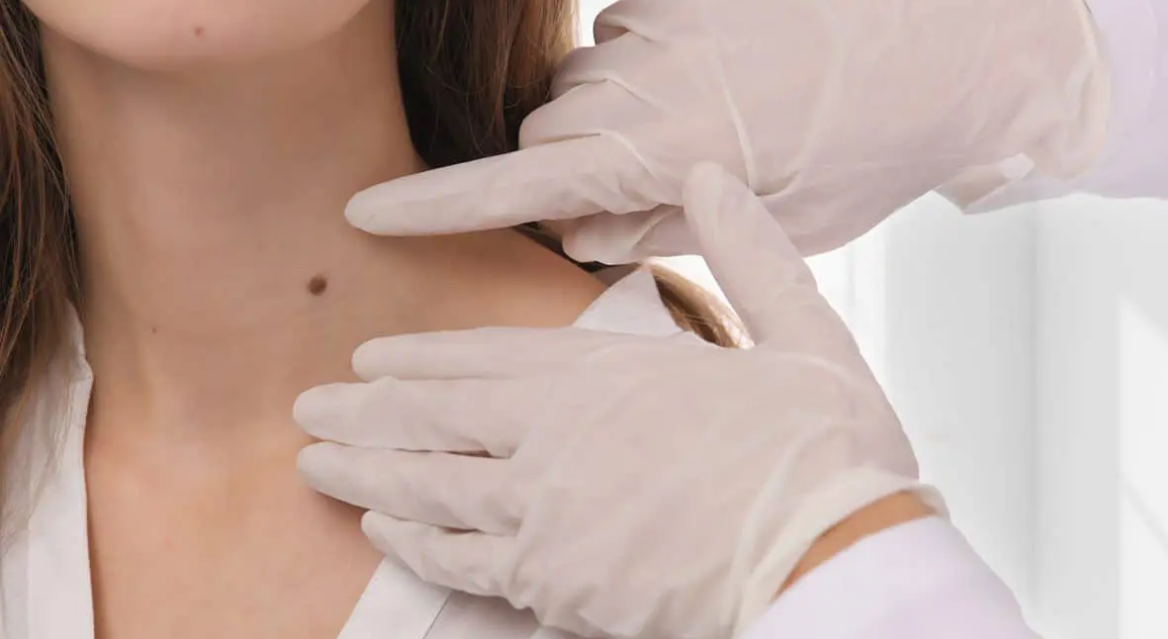 Reasons Why You Should See A Dermatologist For Skin Tag Removal